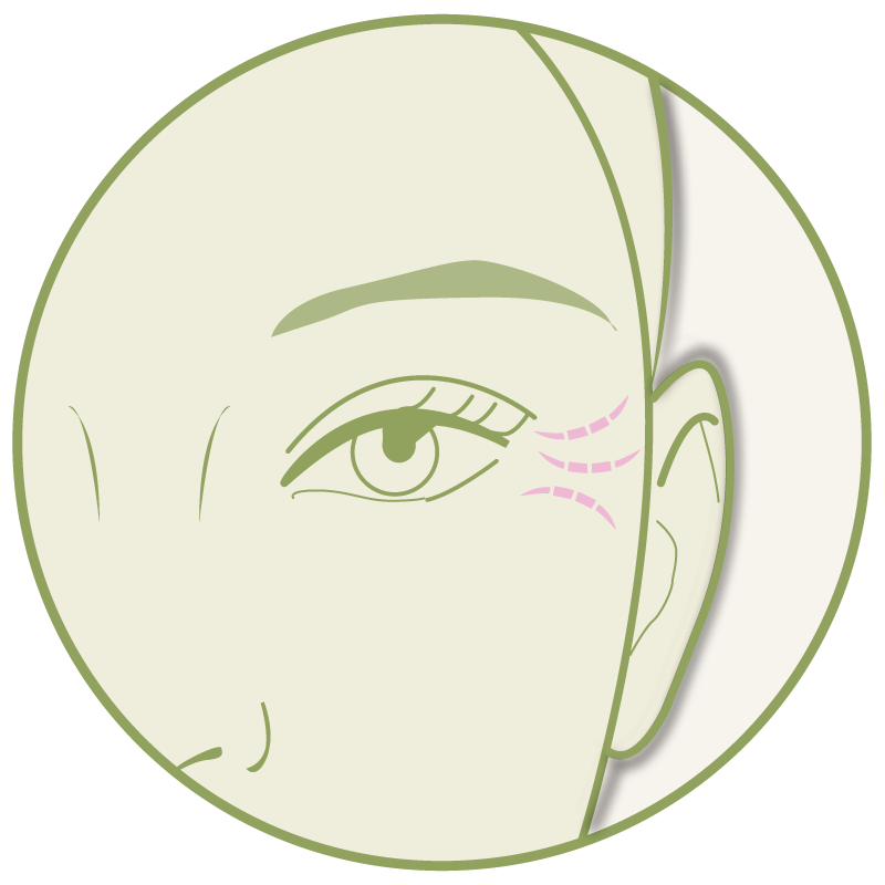 Krähenfüße – Platzhalter