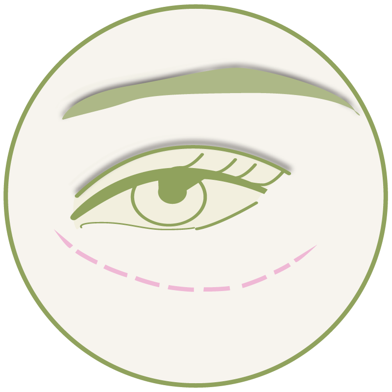 Tränenrinnen – Platzhalter