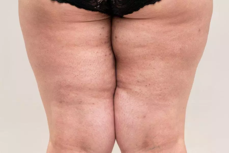 Fat legs with acne on skin, obesity female body on gray background