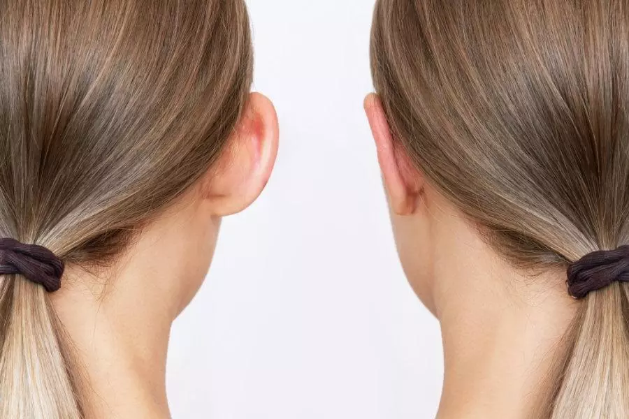 Cropped shot of woman's head with ears before and after otoplasty isolated on a white background. Result of cosmetic plastic surgery of correction auricles and getting rid of lop - eared